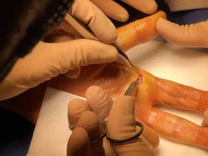 Les blessures dues aux couteaux à huîtres nécessitent quelque fois des interventions chirurgicales