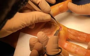 Les blessures au couteau à huîtres explosent à Noël (2000 graves)