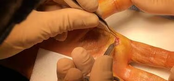 Les blessures au couteau à huîtres explosent à Noël (2000 graves)